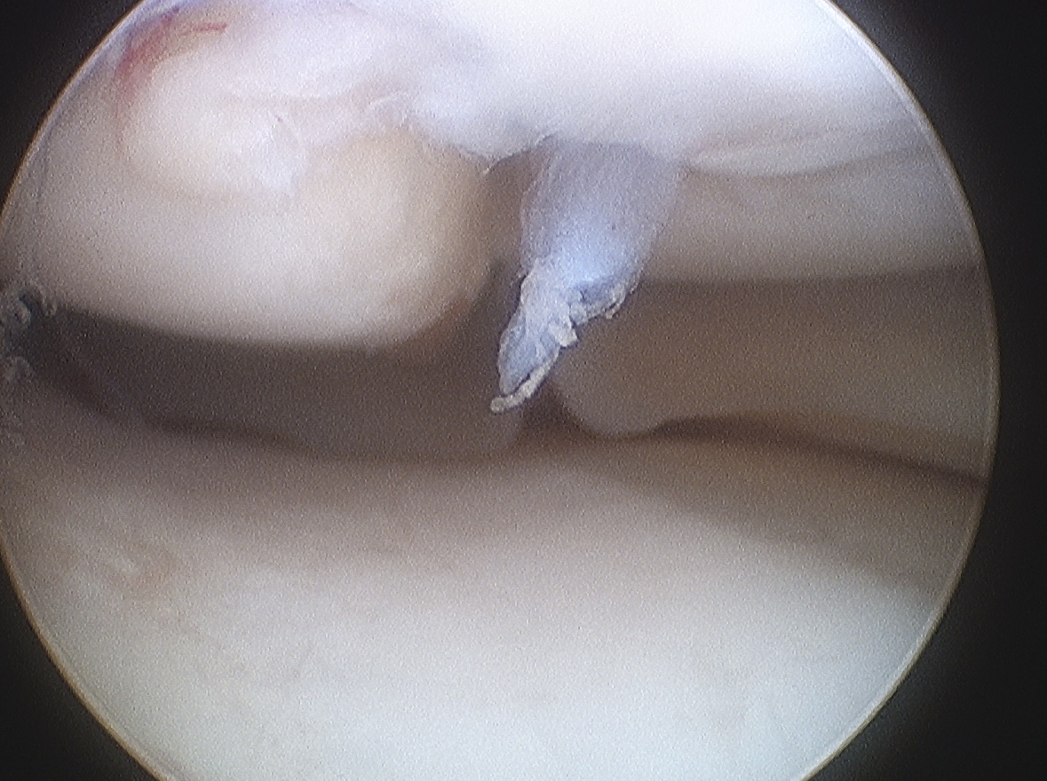 Type 4 Knee OCD Arthroscopy